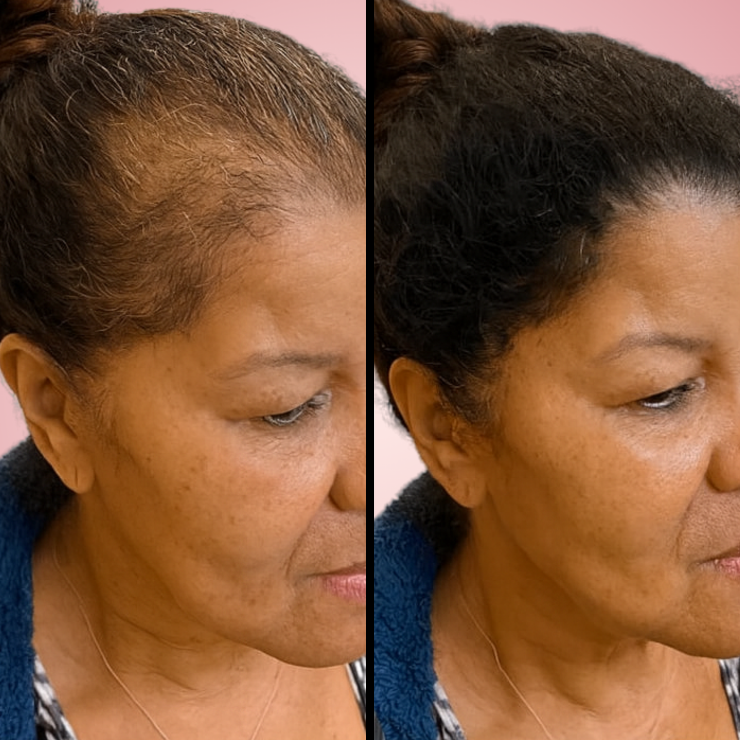 Sérum Densifiant & Anti-Chute Cheveux | Lyra®