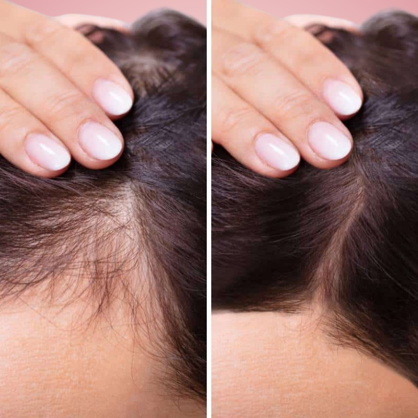 Sérum Densifiant & Anti-Chute Cheveux | Lyra®